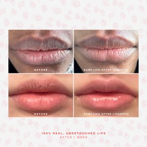 LipSoftie® Lip Treatment