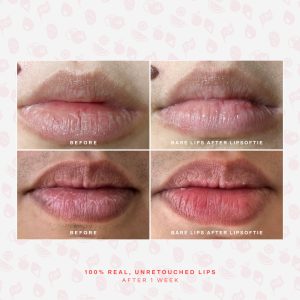 LipSoftie® Lip Treatment
